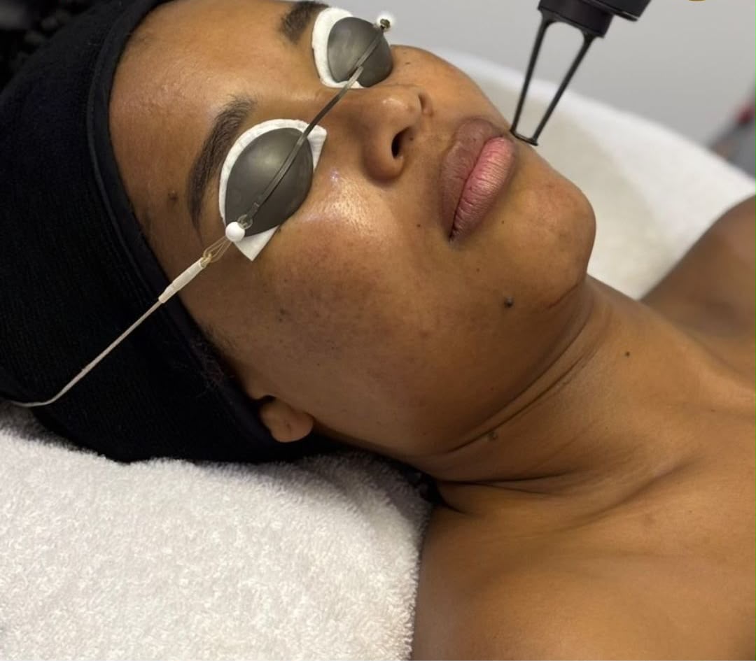 Fractional laser resurfacing at Arziki Aesthetics