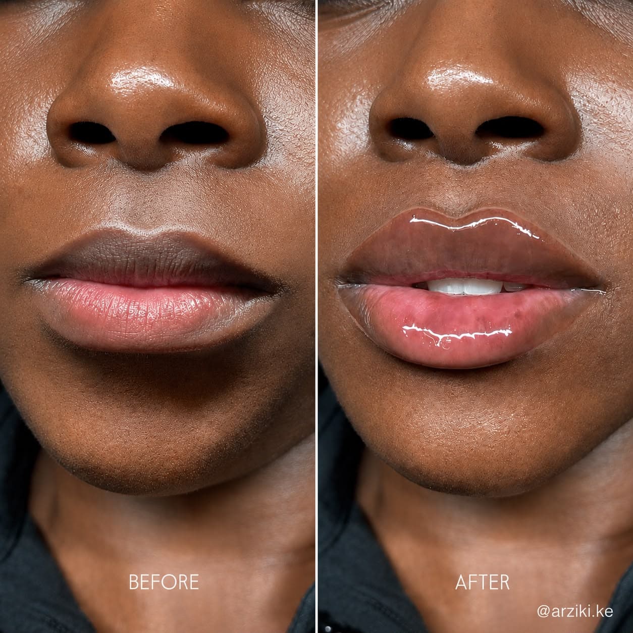 Lip filler at Arziki Aesthetics