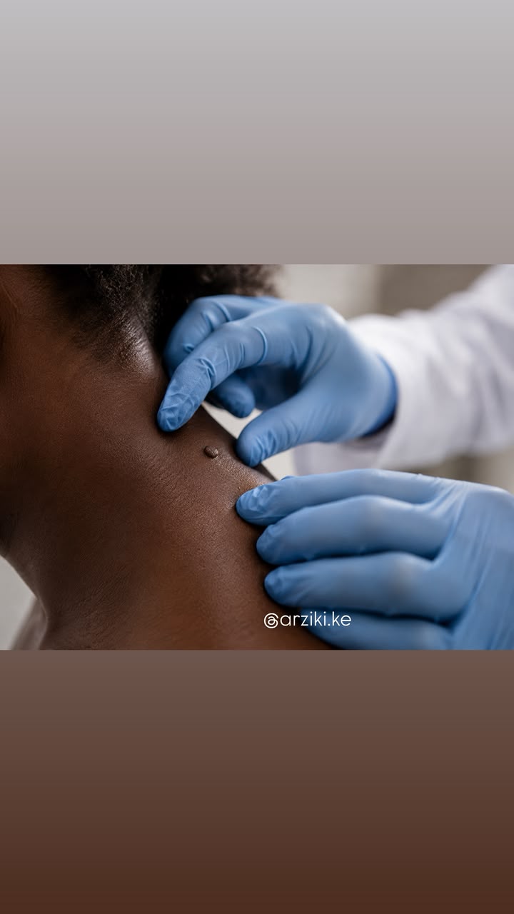 Skin tag removal at Arziki Aesthetics